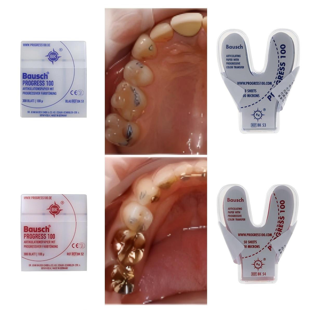 Bausch BK51 BK52 BK53 BK54 Den - Bite Indicator recension och pris
